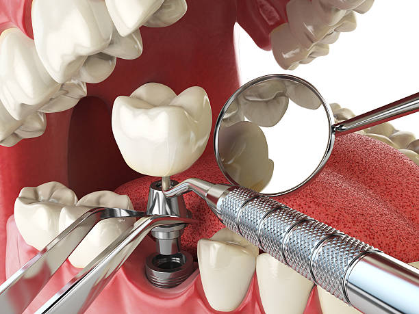 Best Emergency Tooth Extraction in Evans, CO